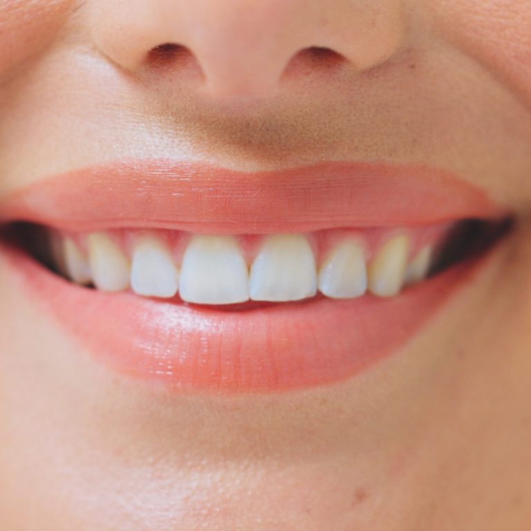 Smile Correction Treatment in TVM | Darling Dental Care